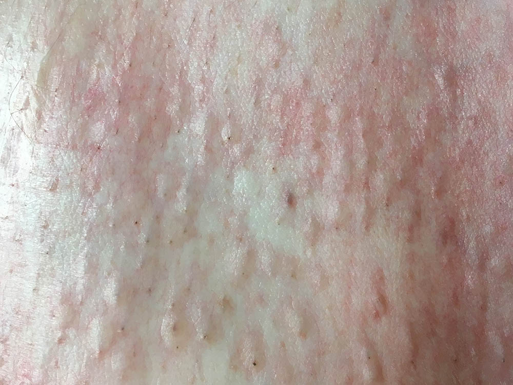 Épilation Laser Centre Laser Dermatologique du Limousin